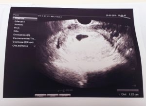 Статьи об абортах (прерывании беременности)