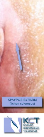 Осветление участка кожи слизистой при краурозе вульвы