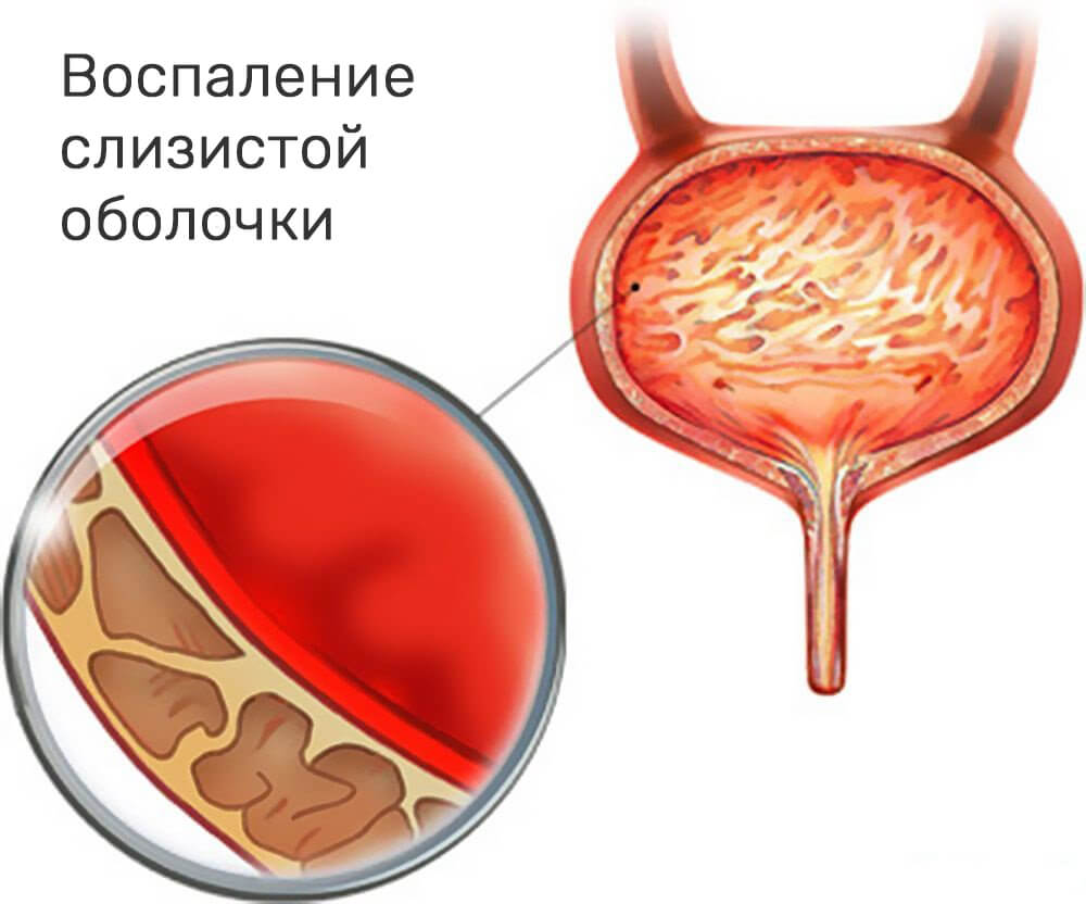 Лечение в гинекологии – воспаление шейки матки и других женских органов